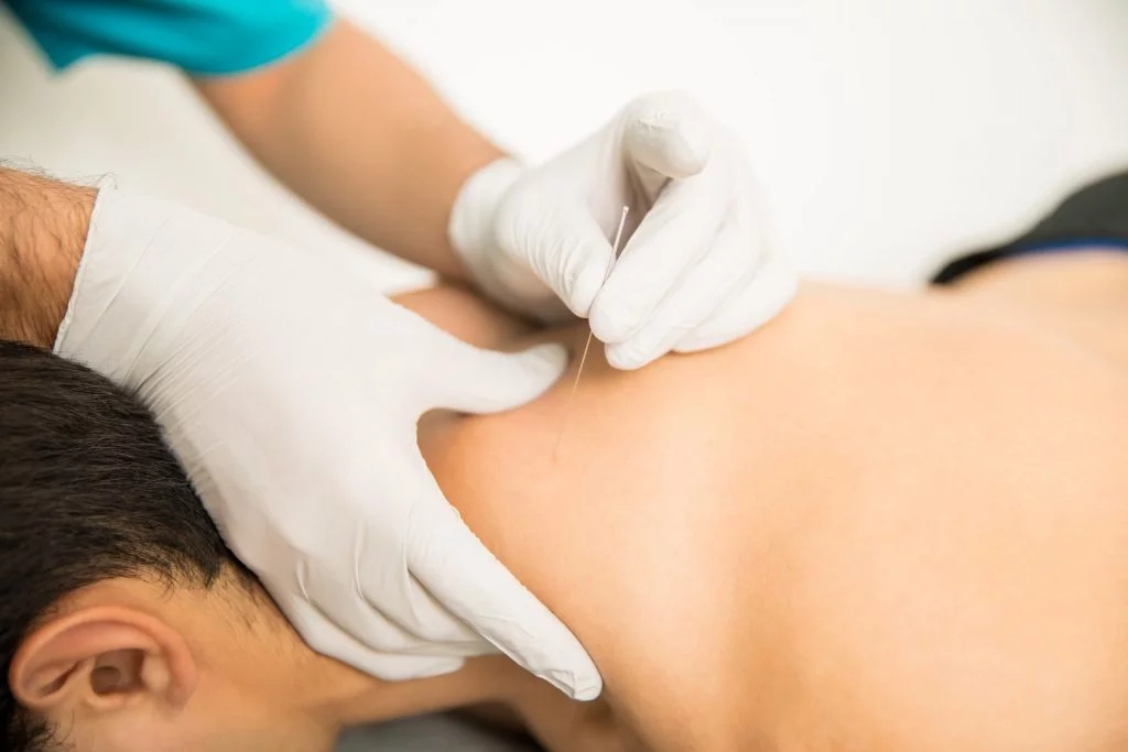 Dry Needling Physical Therapy
